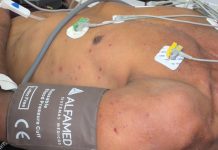 Seis pessoas ficam feridas após ataque de abelhas em acampamento, em João Pessoa